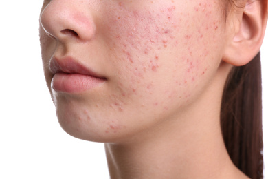 Teenage girl with acne problem on white background, closeup