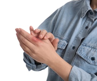 Woman with burn of her hand on white background, closeup