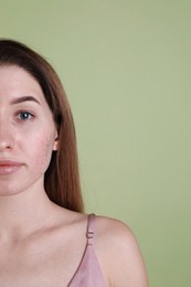 Photo of Young woman with acne problem on olive background. Space for text