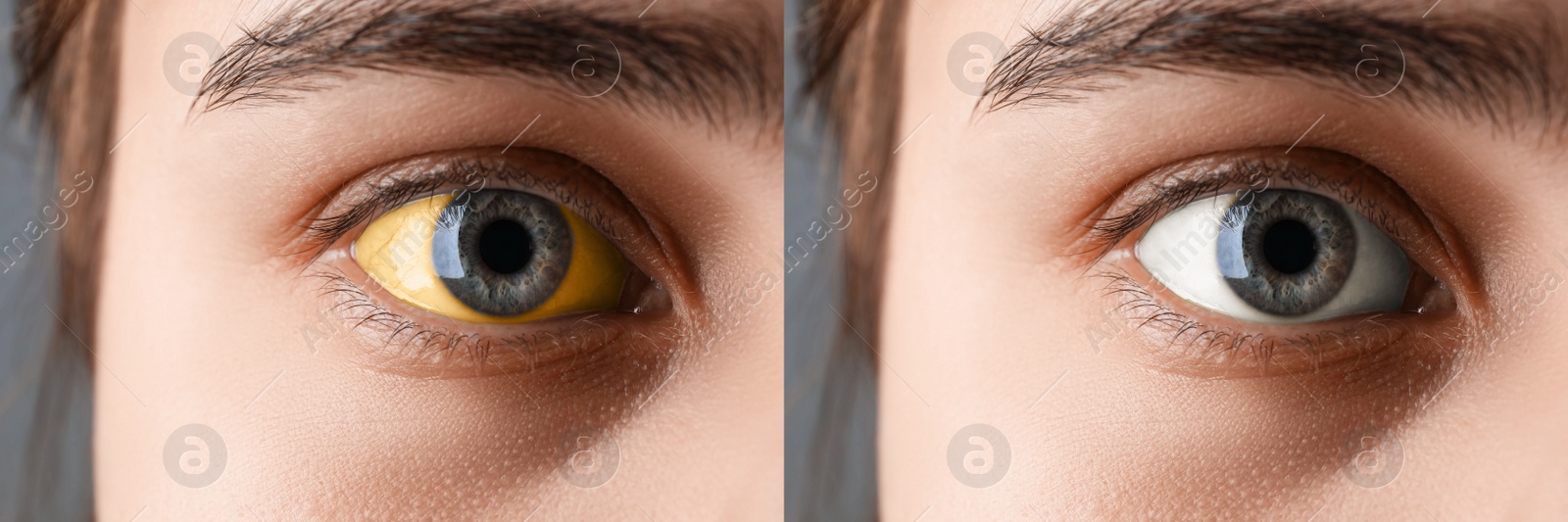 Image of Collage with photos of woman before and after hepatitis treatment, focus on eyes. Banner design