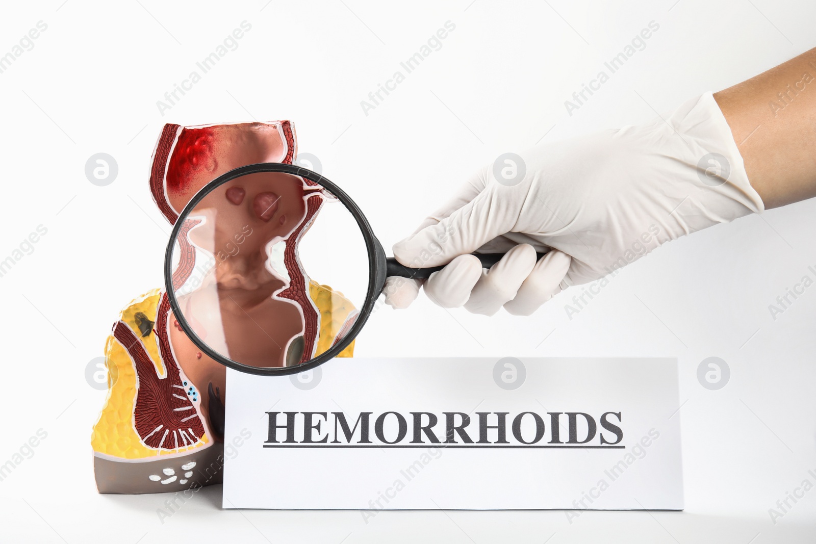 Photo of Proctologist holding magnifying glass near anatomical model of rectum with hemorrhoids isolated on white, closeup