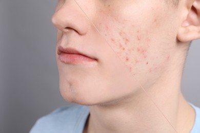 Acne problem, collage. Photo of man divided into halves before and after treatment on grey background, closeup