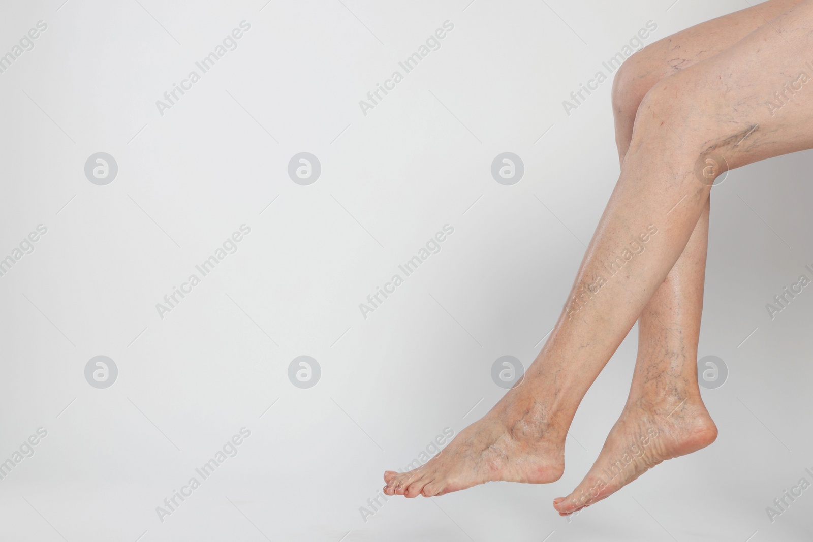 Photo of Closeup view of woman with varicose veins on light background. Space for text