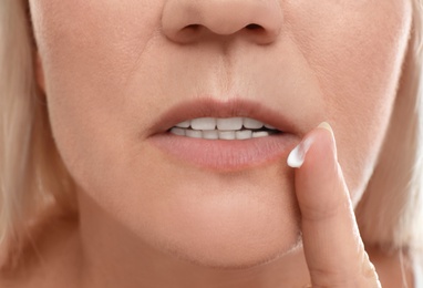 Woman with cold sore applying cream on lips, closeup