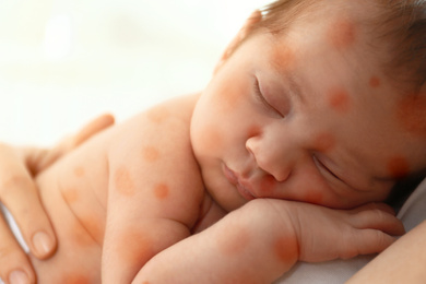 Mother holding her little child with red rash on light background. Baby allergies