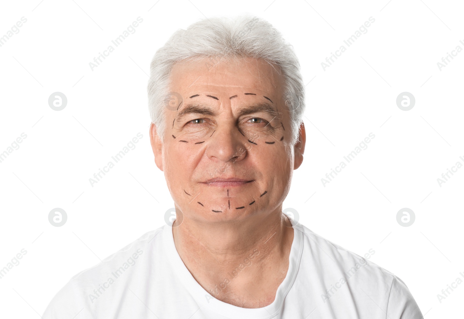 Photo of Mature man with marks on face for cosmetic surgery operation against white background