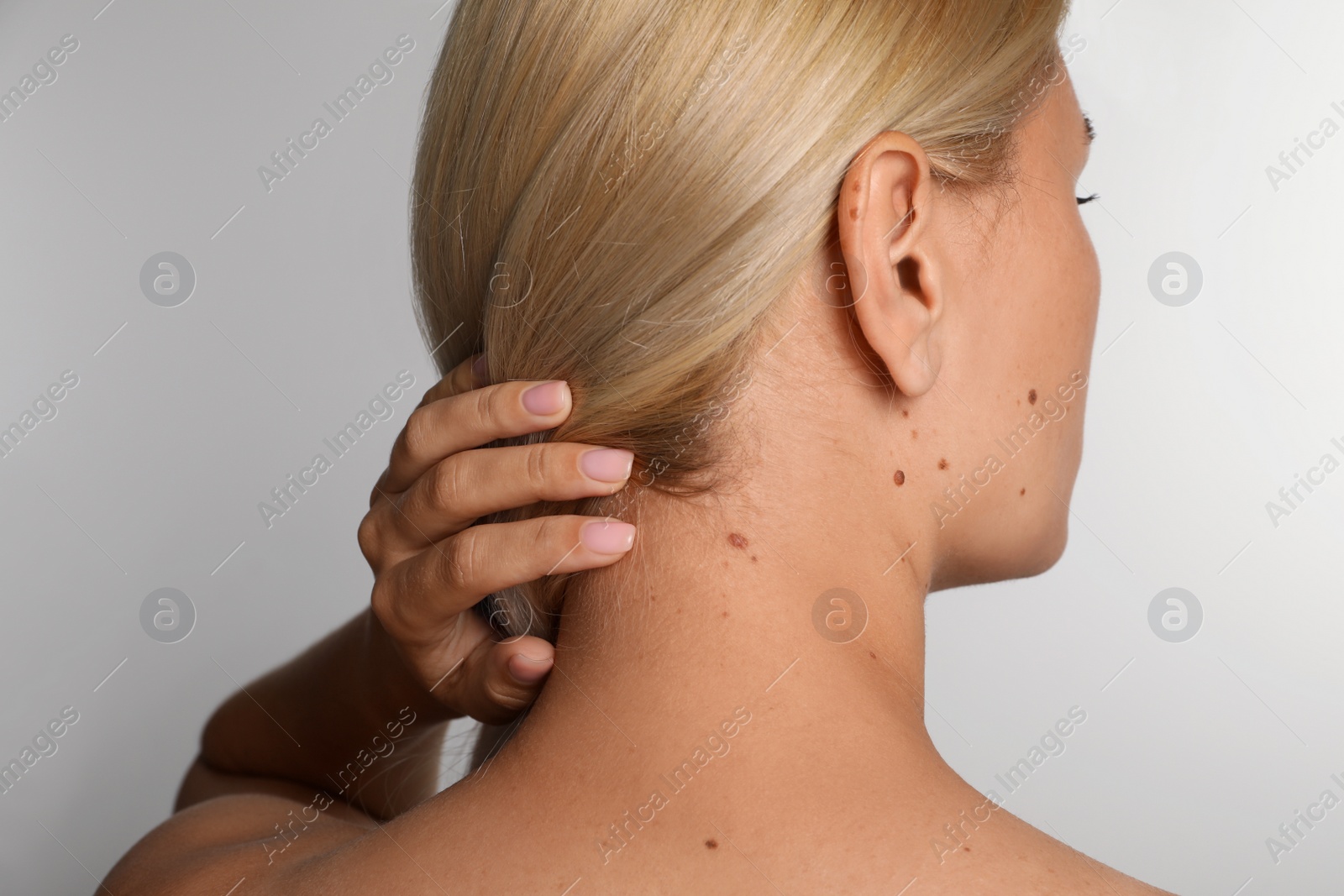 Photo of Woman with birthmarks on light grey background, back view