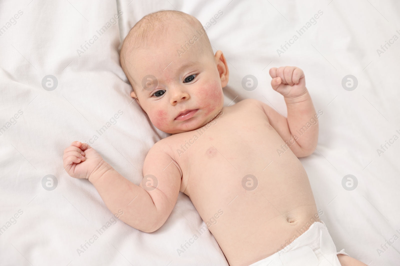 Photo of Cute little baby with allergic redness on cheeks lying on white blanket