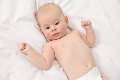 Photo of Cute little baby with allergic redness on cheeks lying on white blanket