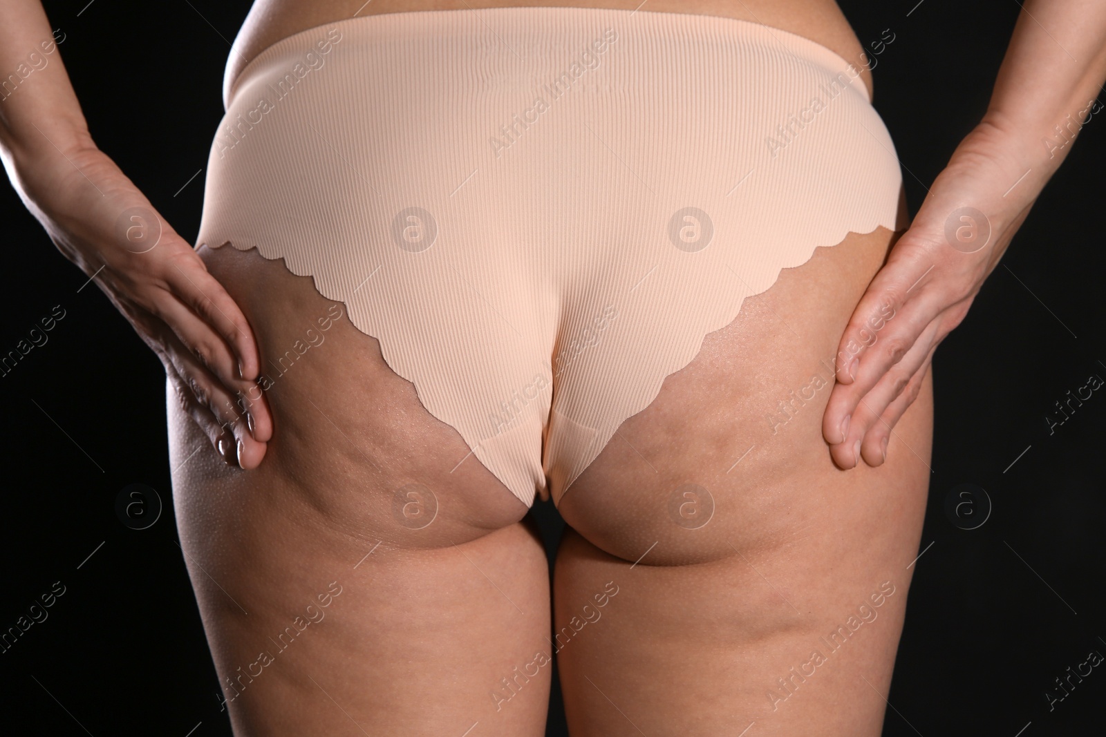 Photo of Woman with cellulite on black background, closeup