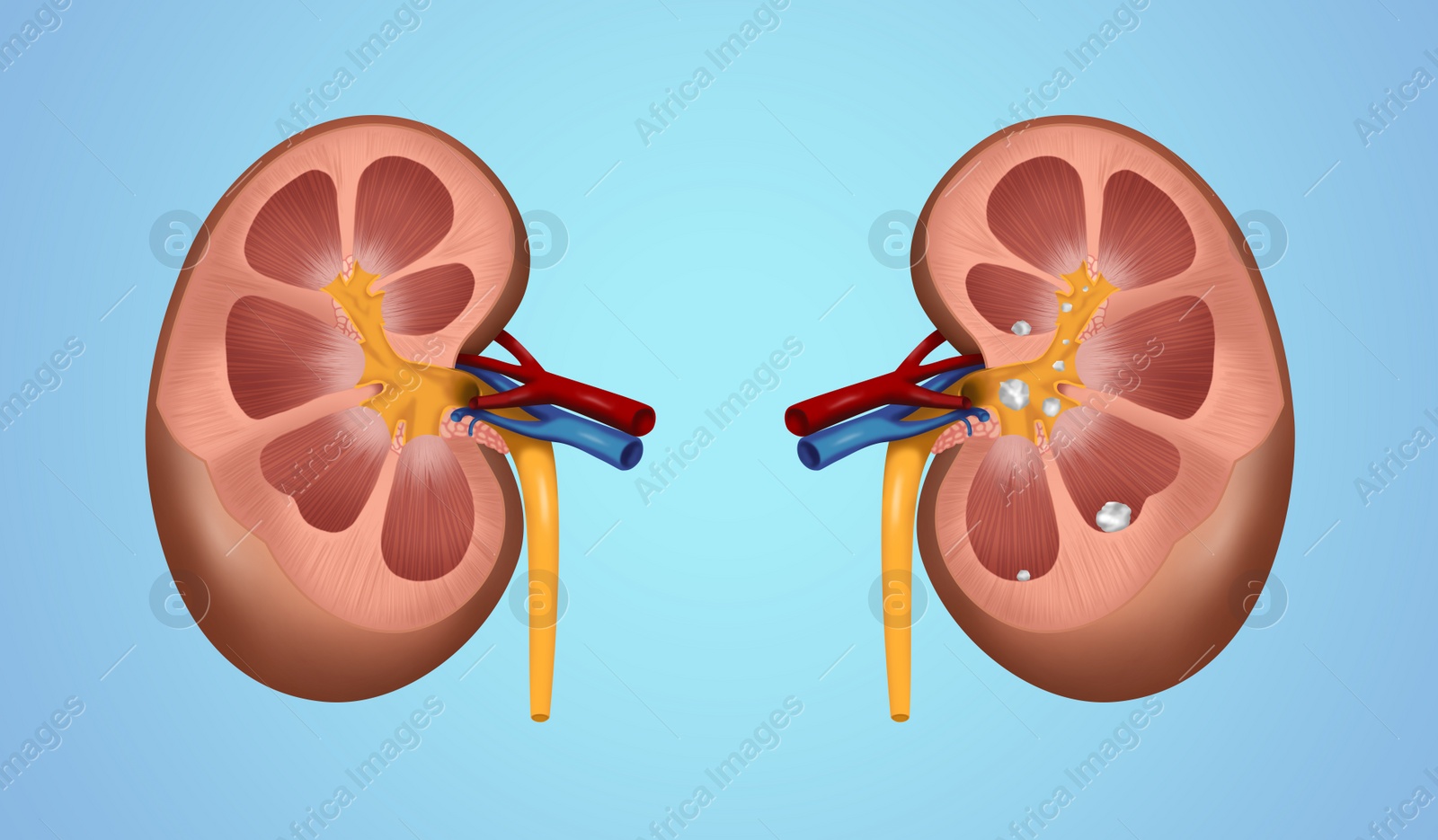 Illustration of  human kidney stones on blue background. Banner design