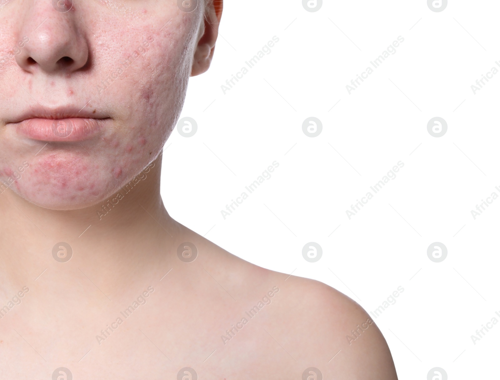 Photo of Young woman with acne problem on white background