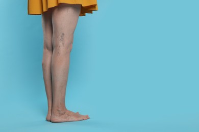 Closeup view of woman with varicose veins on light blue background. Space for text