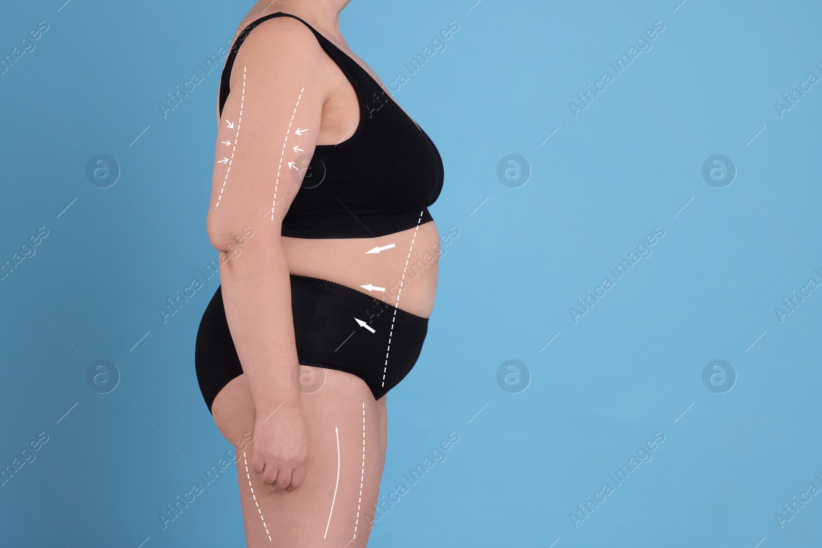 Image of Woman with marks on body before cosmetic surgery operation on light blue background, closeup