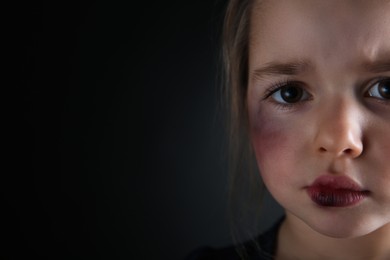 Photo of Closeup viewlittle girl with bruises on face against dark background, space for text. Domestic violence victim