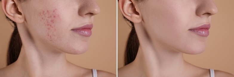 Image of Acne problem. Young woman before and after treatment on beige background, closeup. Collage of photos