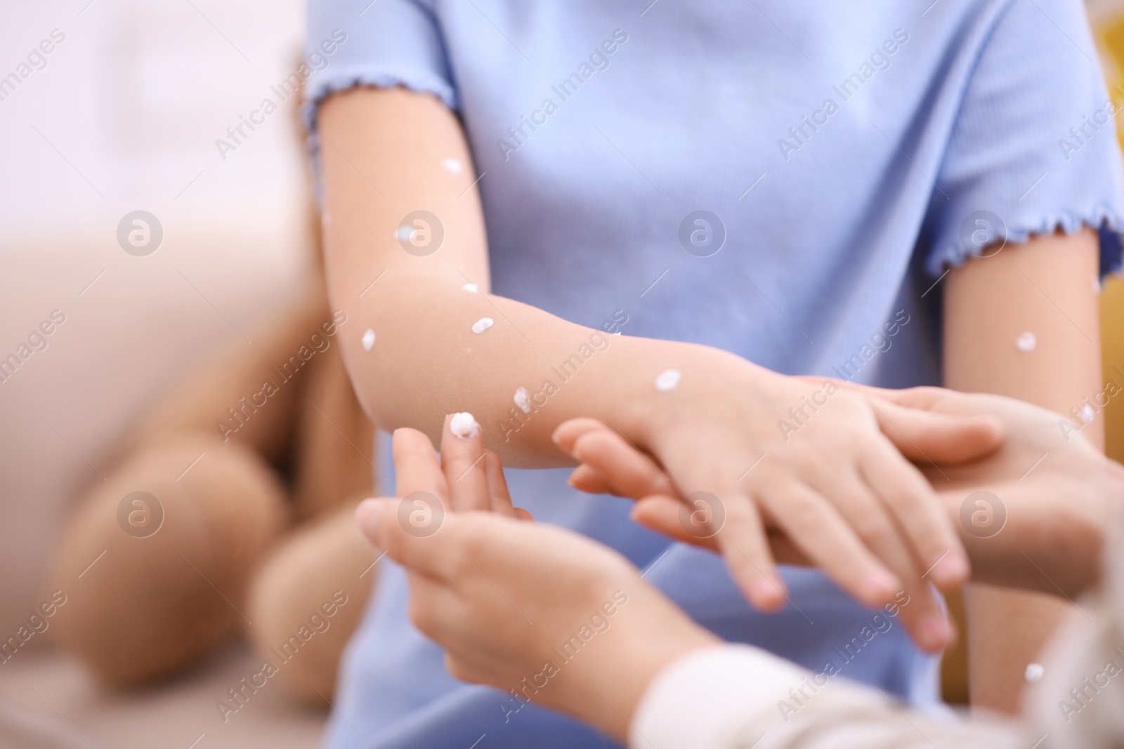 Photo of Mother applying cream onto skin of her daughter with chickenpox at home, closeup