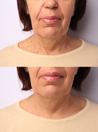 Image of Woman looking better due to cosmetic procedures. Collage with photos on white background before and after rejuvenation, closeup