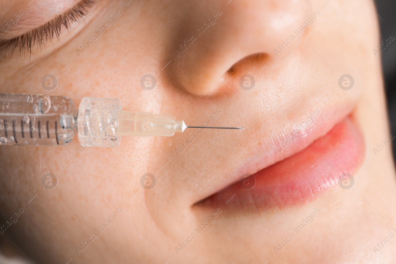 Photo of Client getting lips injection, closeup. Cosmetology procedure