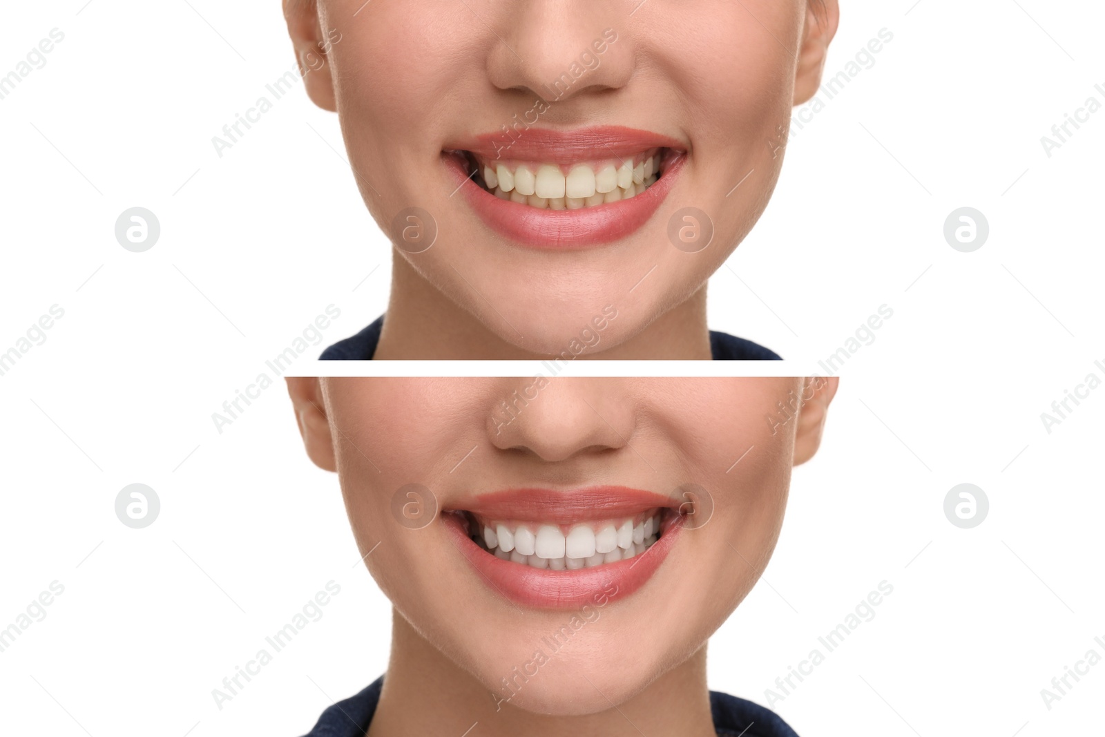 Image of Woman showing teeth before and after whitening on white background, collage
