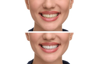 Image of Woman showing teeth before and after whitening on white background, collage