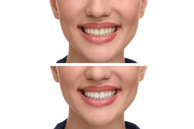 Woman showing teeth before and after whitening on white background, collage