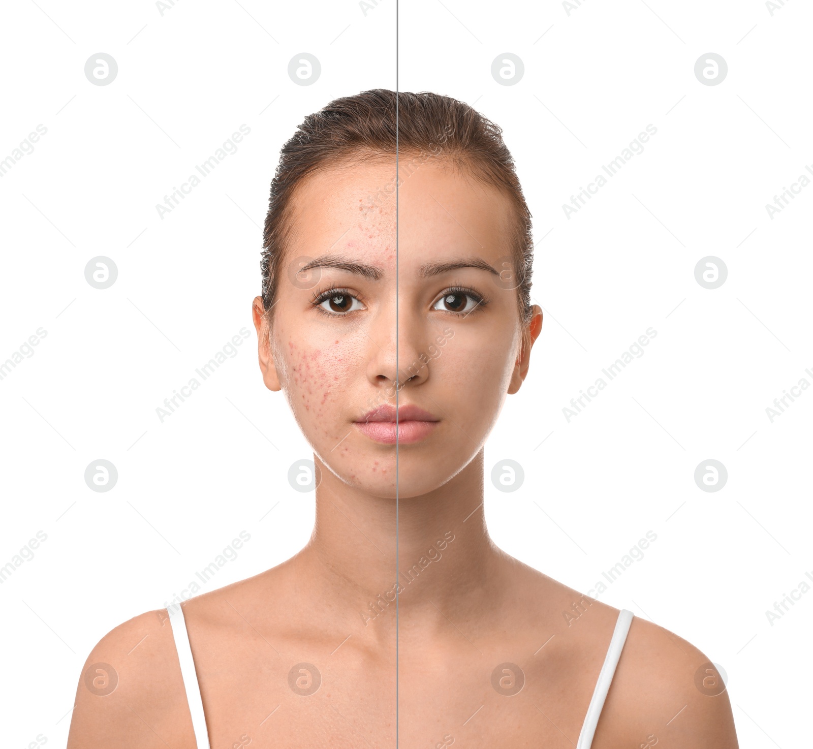 Image of Teenage girl before and after acne treatment on white background