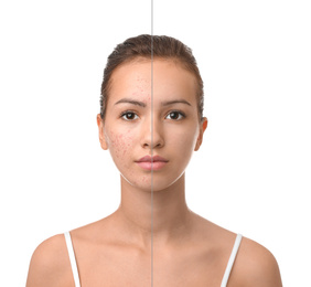 Teenage girl before and after acne treatment on white background