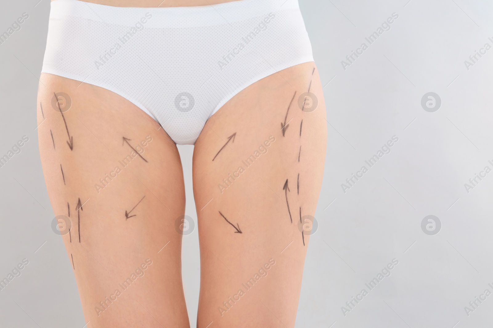 Photo of Woman with marks on body for cosmetic surgery operation against grey background, closeup