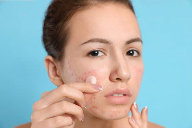 Photo of Teen girl applying acne healing patch on light blue background