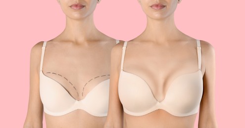 Image of Breast augmentation with silicone implants. Photos of woman before with marks on skin and after with silicone implants, closeup. Collage design on pink background