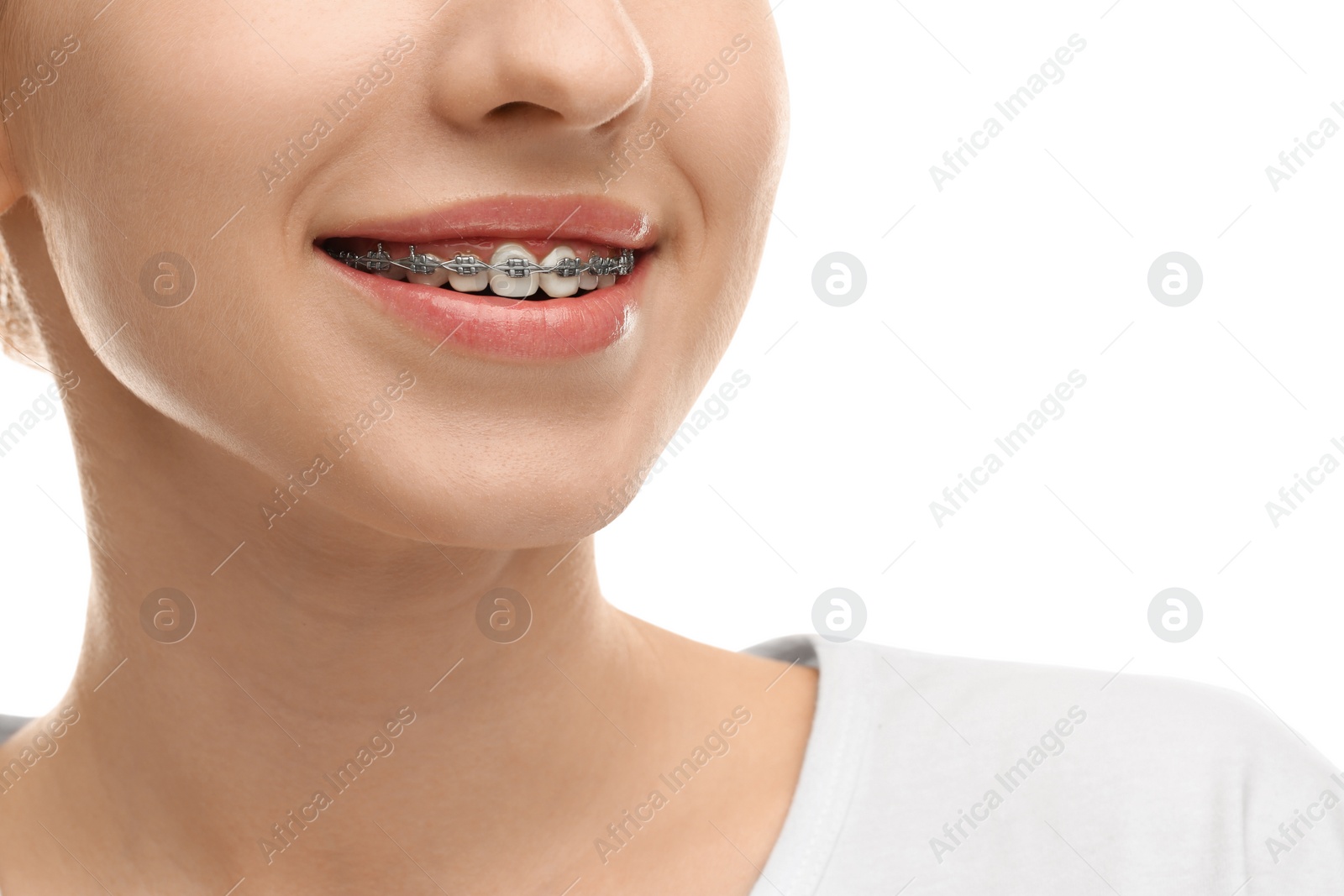 Photo of Smiling woman with dental braces on white background, closeup