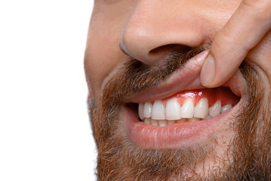 Man showing inflamed gum on white background, closeup