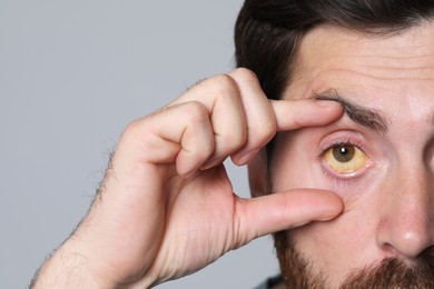 Photo of Man with yellow eyes on grey background, closeup. Symptom of hepatitis