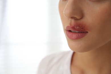 Photo of Woman with herpes on lip against light background, closeup