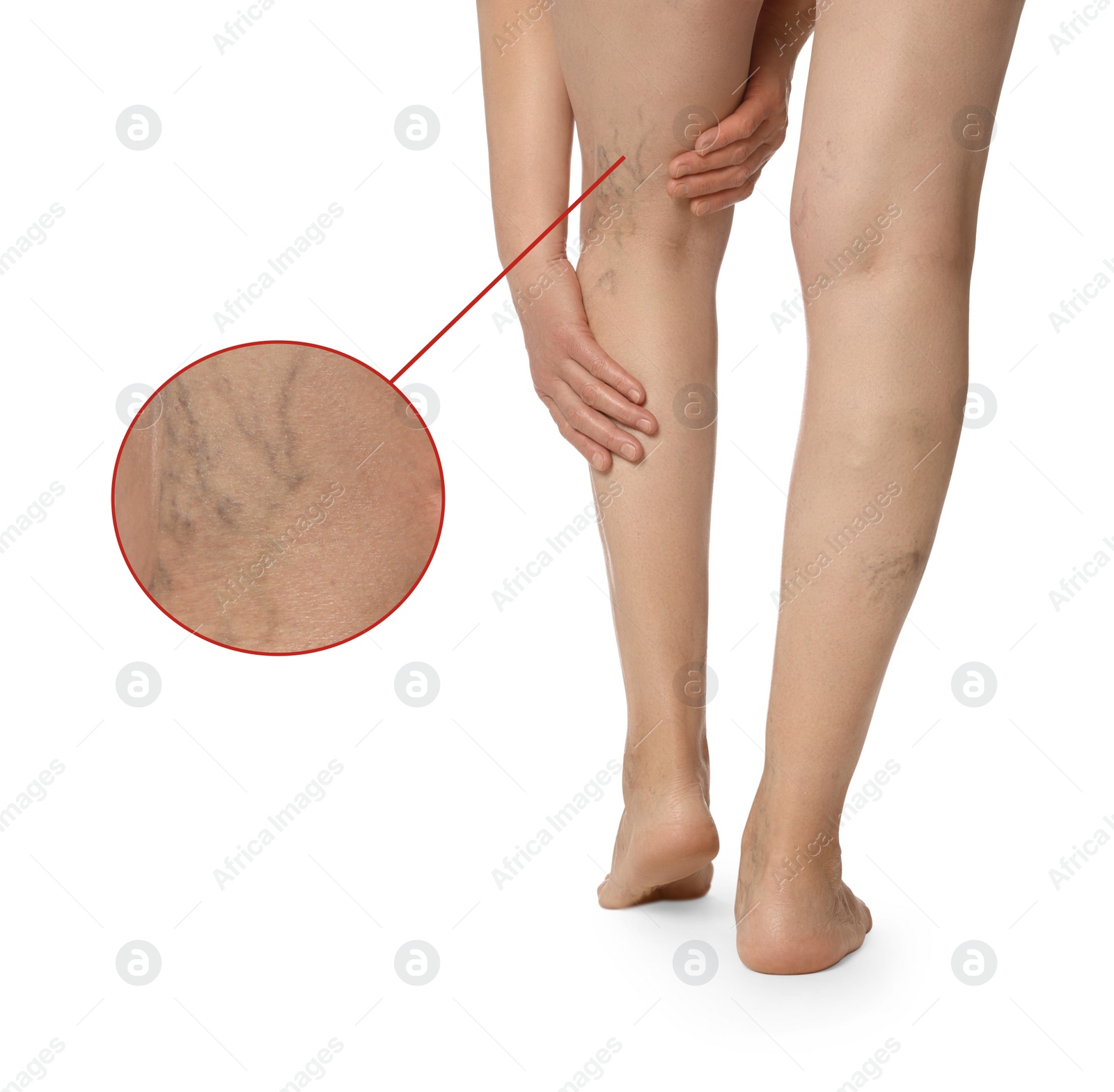 Image of Woman suffering from varicose veins on white background, closeup. Magnified skin surface showing affected area