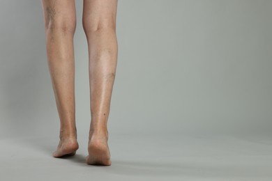 Photo of Closeup view of woman with varicose veins on light grey background. Space for text