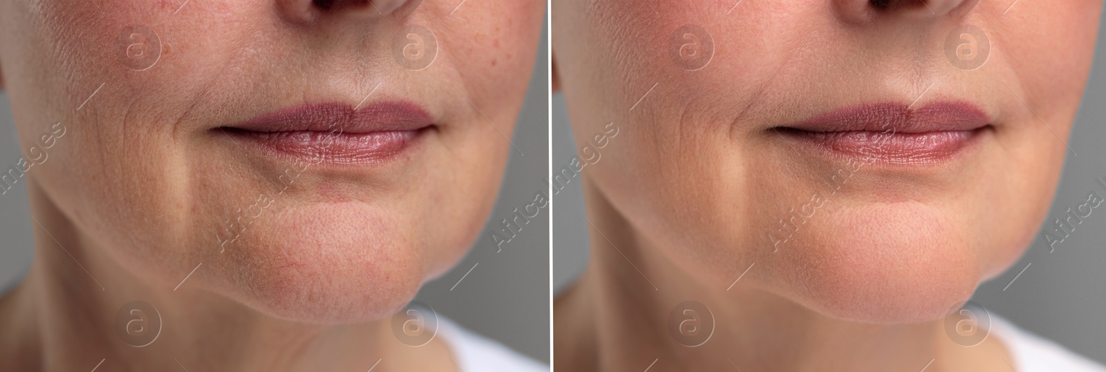 Image of Aging skin changes. Collage with photos of mature woman before and after cosmetic procedure on grey background, closeup