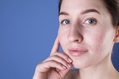 Young woman with acne problem on blue background. Space for text