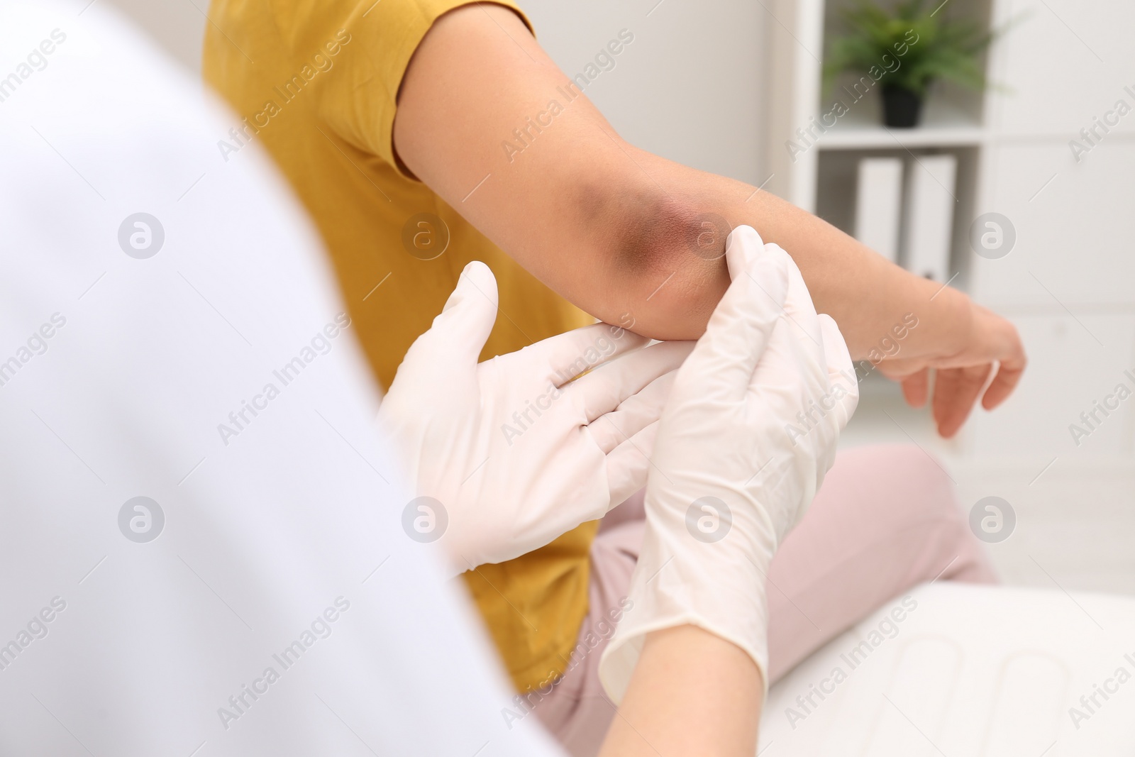 Photo of Doctor examining woman with bruise on elbow in clinic, closeup