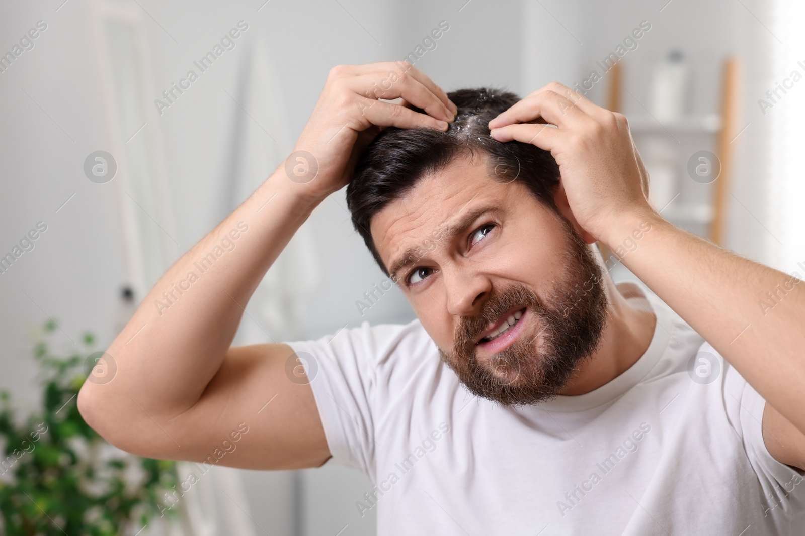 Photo of Emotional man with dandruff in his dark hair at home