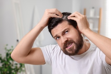 Photo of Emotional man with dandruff in his dark hair at home