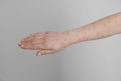 Woman with rash suffering from monkeypox virus on light grey background, closeup