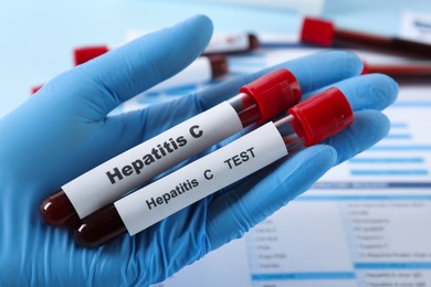 Photo of Scientist holding tubes with blood samples for hepatitis virus test near laboratory form, closeup