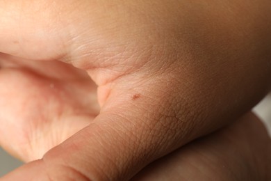 Photo of Closeup view of woman's hand with birthmark