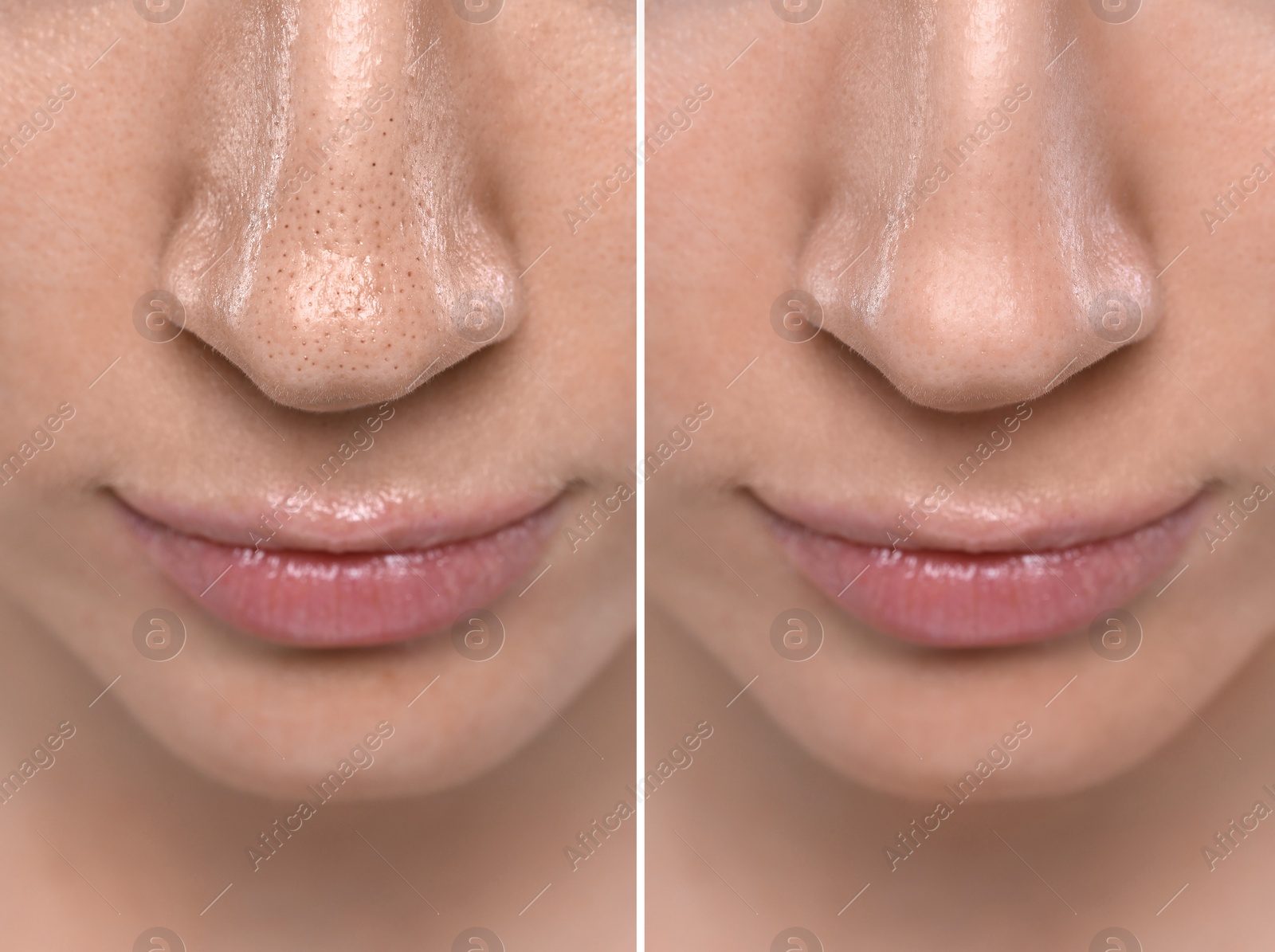 Image of Blackhead treatment, before and after. Collage with photos of woman, closeup view