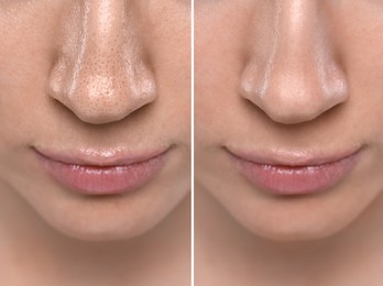 Blackhead treatment, before and after. Collage with photos of woman, closeup view