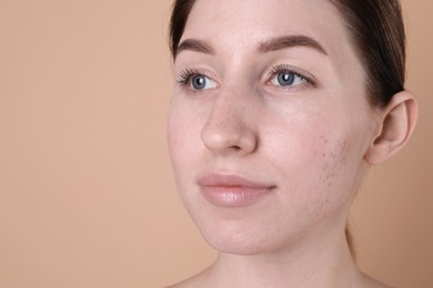 Young woman with acne problem on beige background, closeup. Space for text