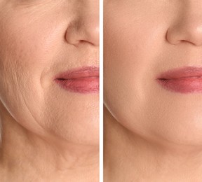 Image of Collage with photos of woman having dry skin problem before and after moisturizing, closeup