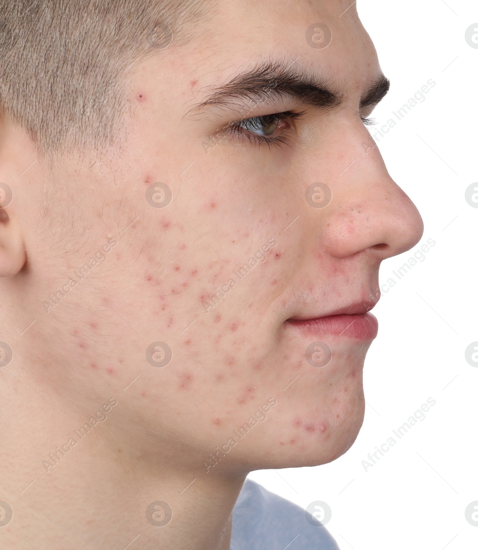 Photo of Young man with acne problem isolated on white, closeup